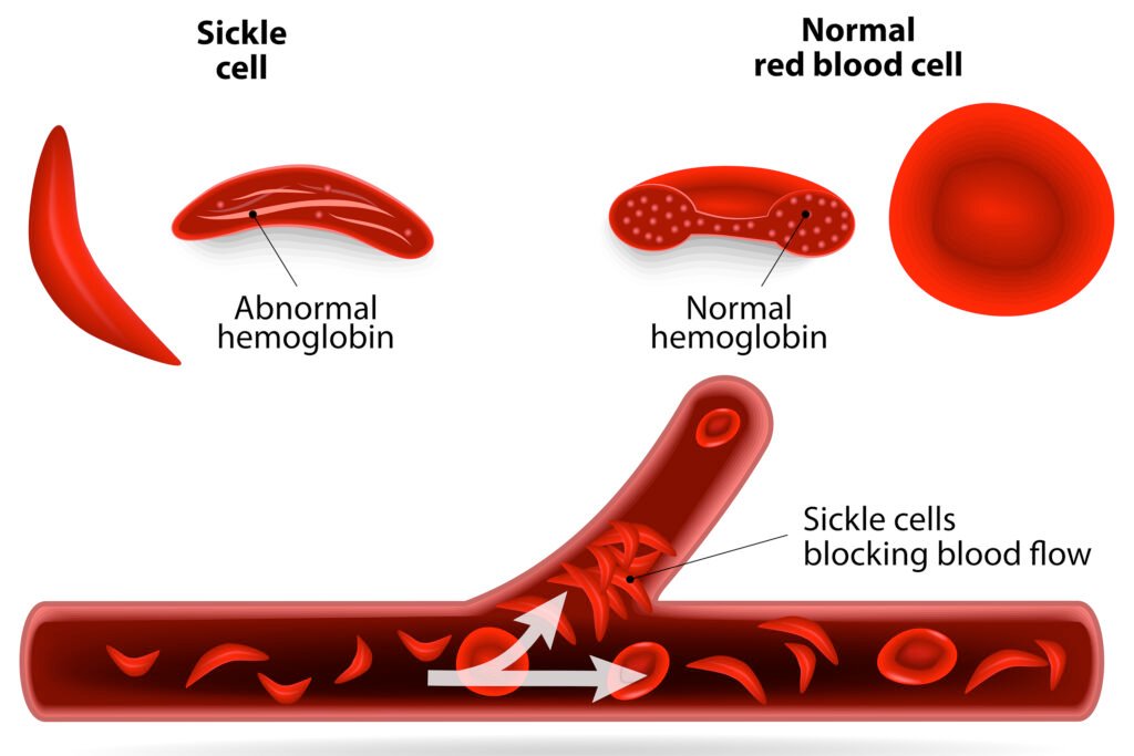 Sickle Cell Disease Cure